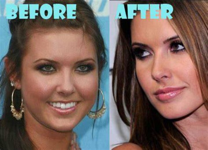 Audrina Patridge Plastic Surgery Before and After
