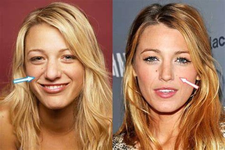 Blake Lively Plastic Surgery Before and After