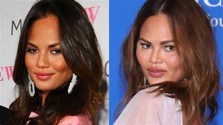 chrissy teigen plastic surgery