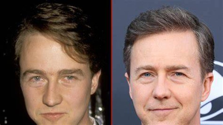 Edward Norton Plastic Surgery Before and After