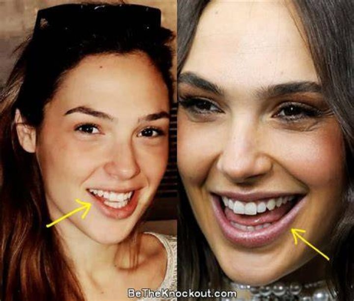 Gal Gadot Plastic Surgery Before and After
