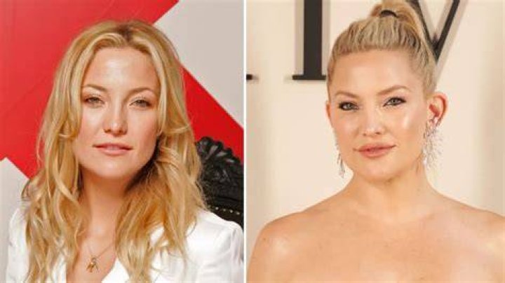 Kate Hudson Plastic Surgery