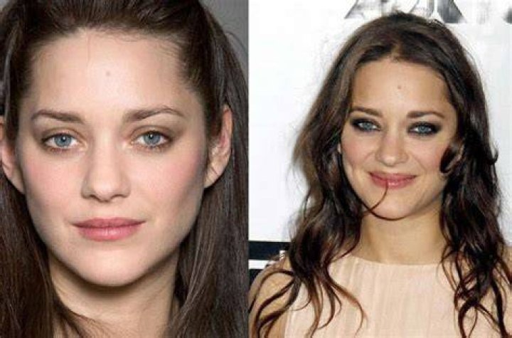 Marion Cotillard Plastic Surgery Before and After