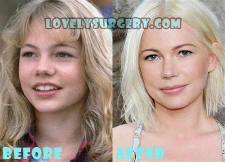 Michelle Williams Plastic Surgery Before and After