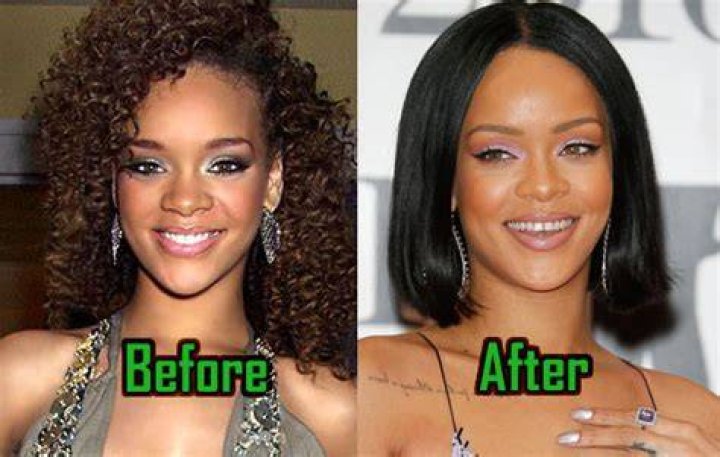 Rihanna Plastic Surgery Before and After